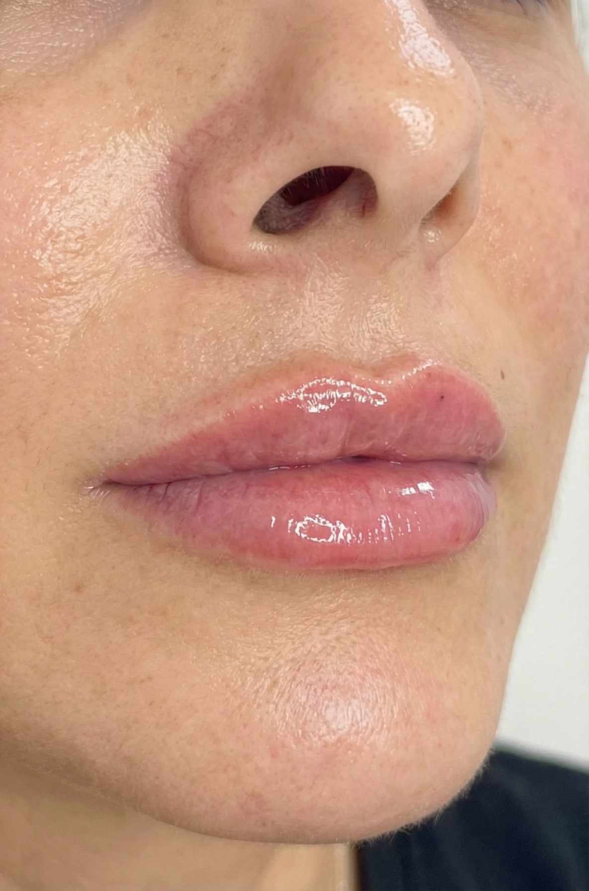 Filler Labbra - dopo il trattamento