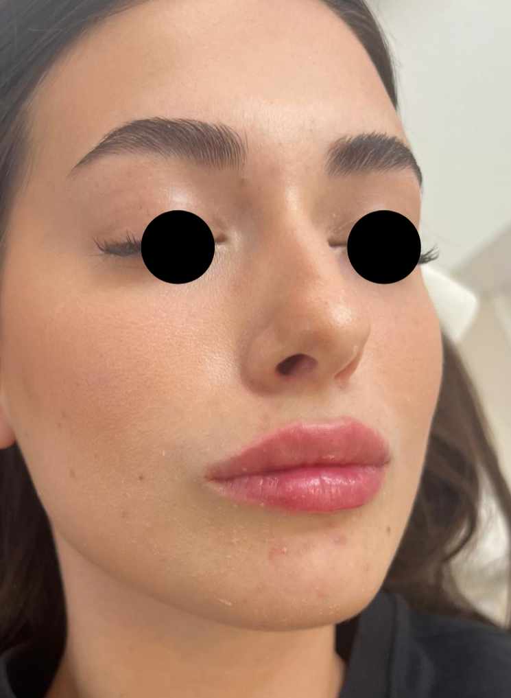 Filler Labbra - dopo il trattamento