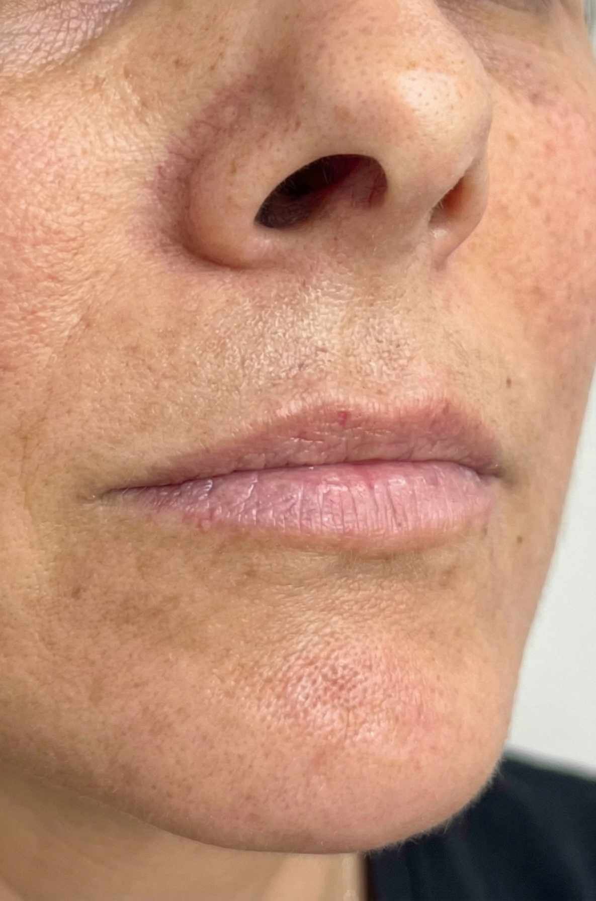 Filler Labbra - prima del trattamento