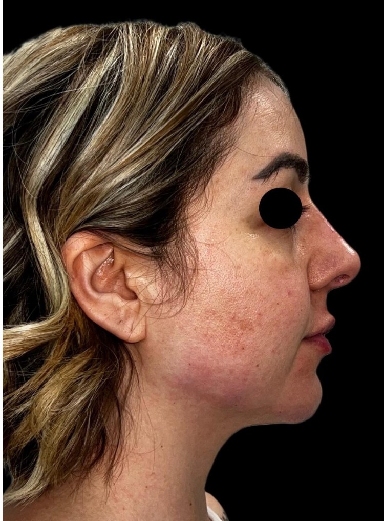 Full Face - dopo il trattamento