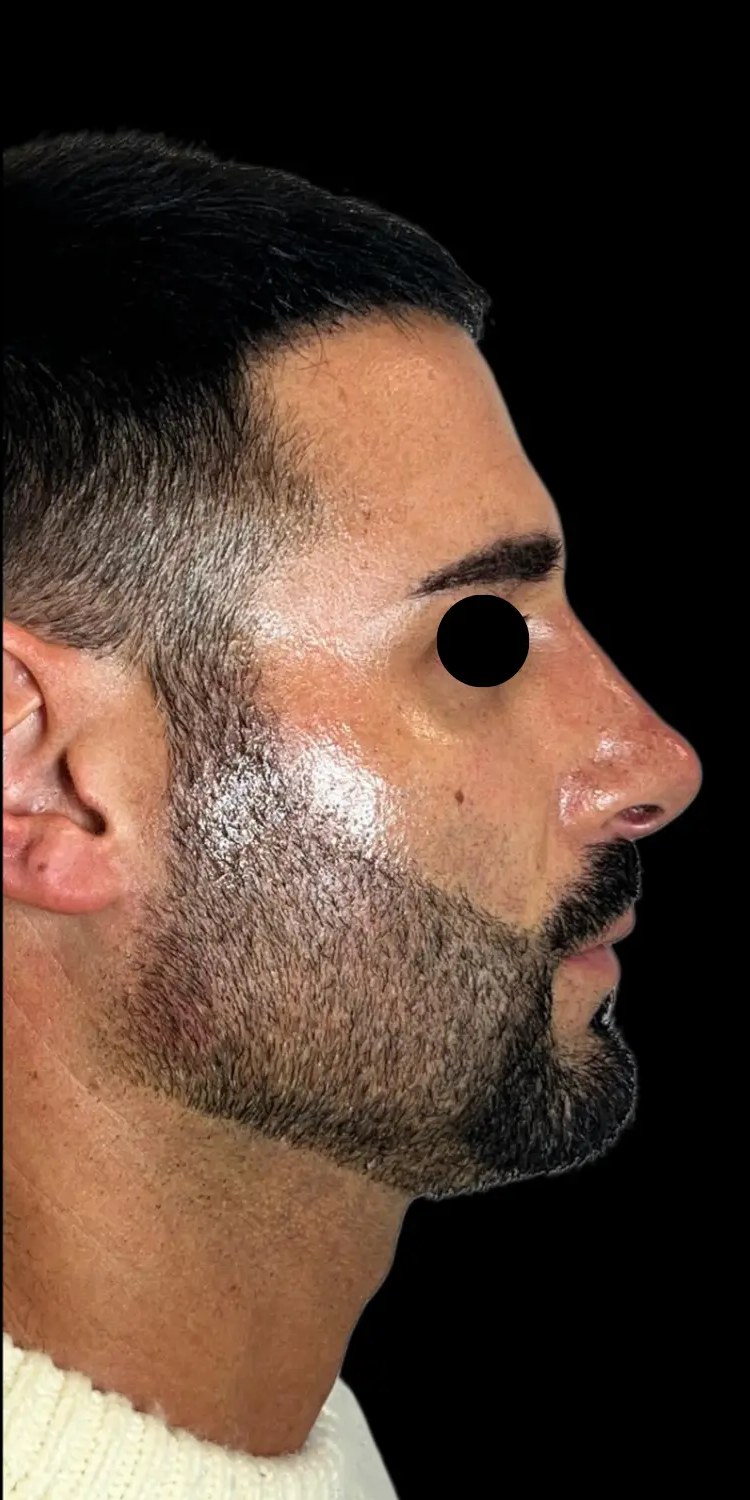 Full Face - dopo il trattamento