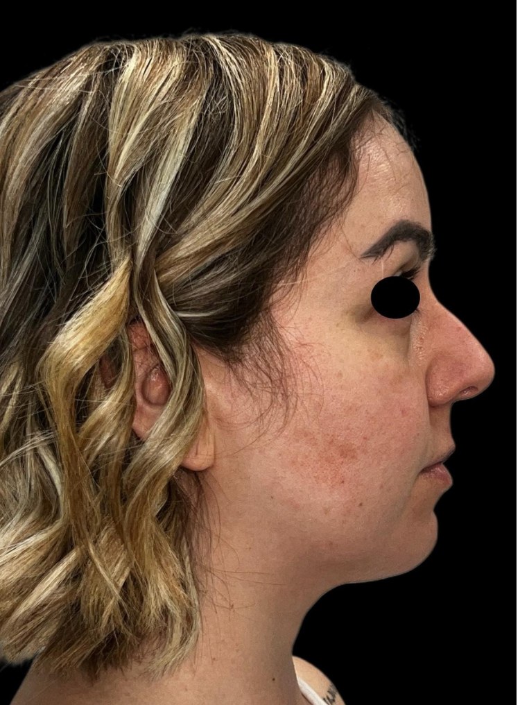 Full Face - prima del trattamento