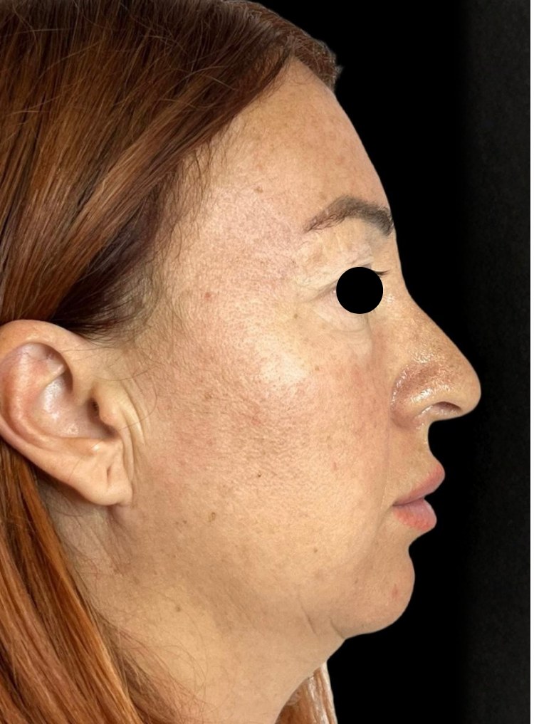 Full Face - prima del trattamento