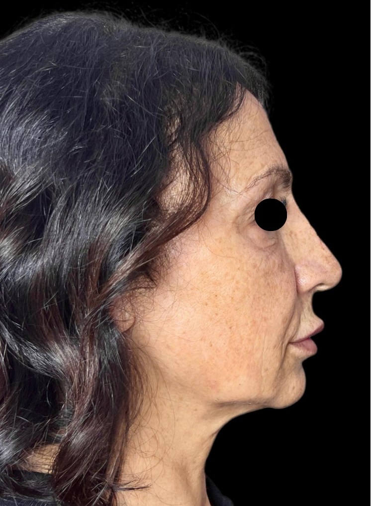 Full Face - prima del trattamento