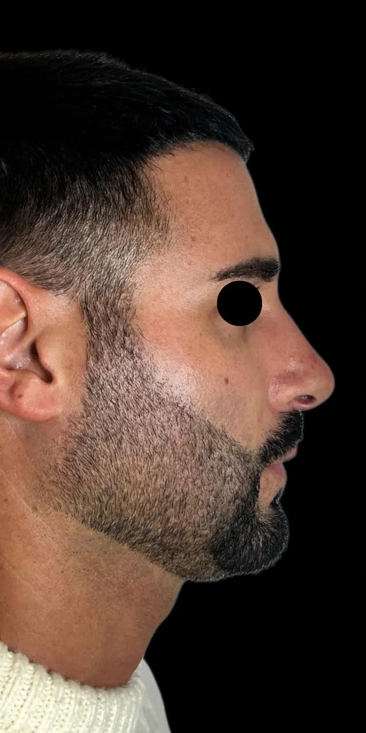 Full Face - prima del trattamento