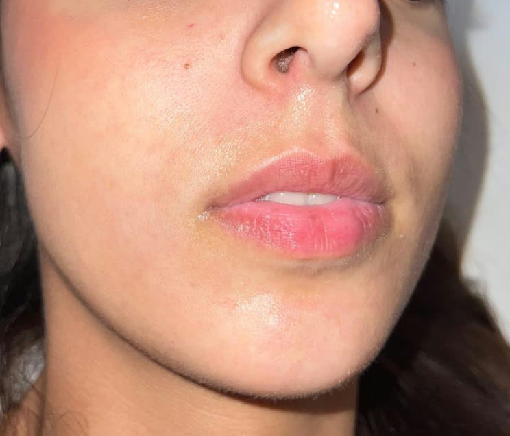 Filler Labbra - prima del trattamento